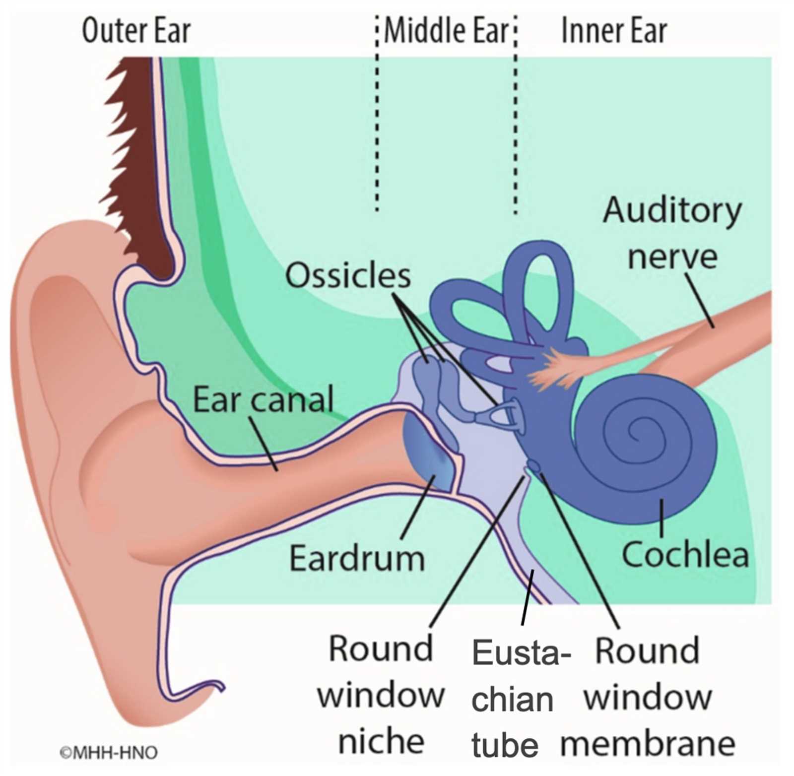 cochlear implant parts diagram