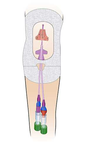 picc line parts diagram