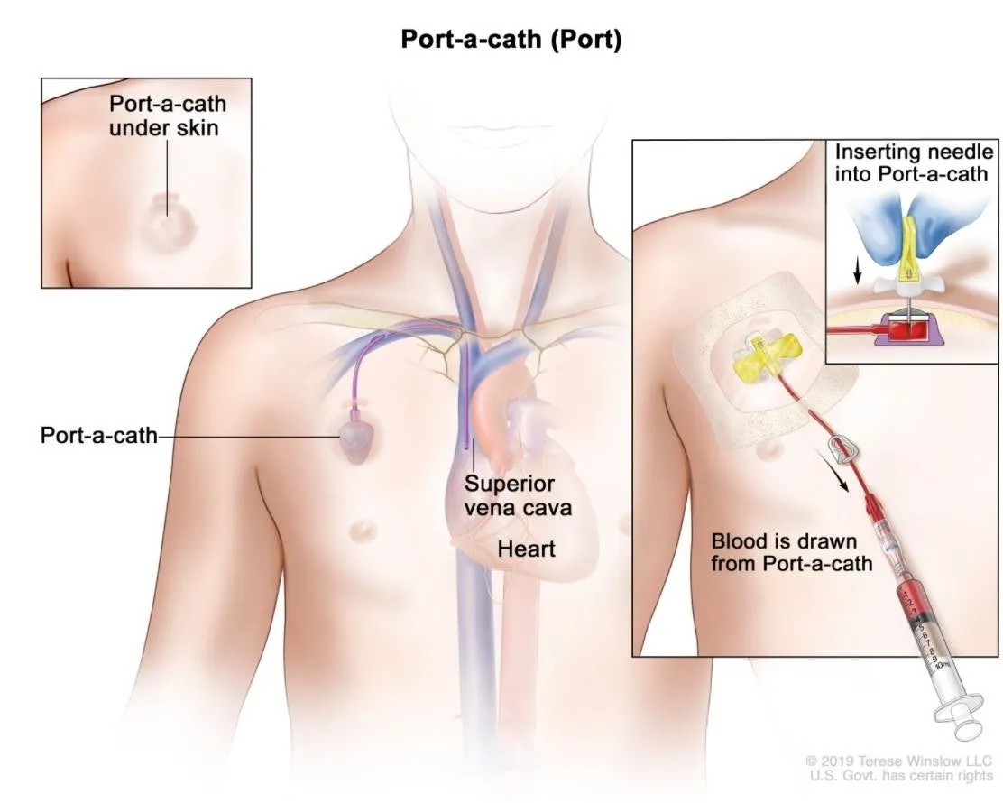 picc line parts diagram