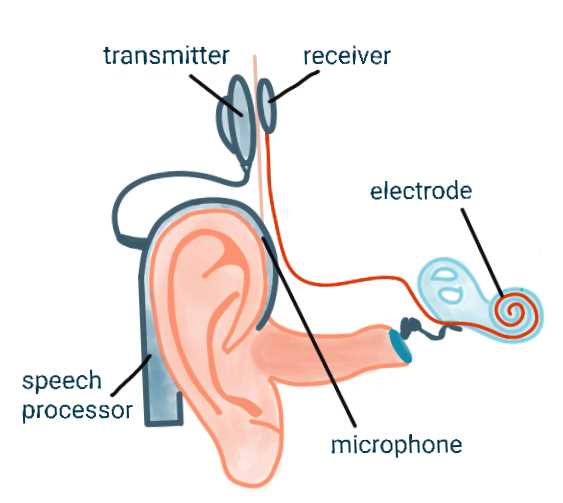 cochlear implant parts diagram