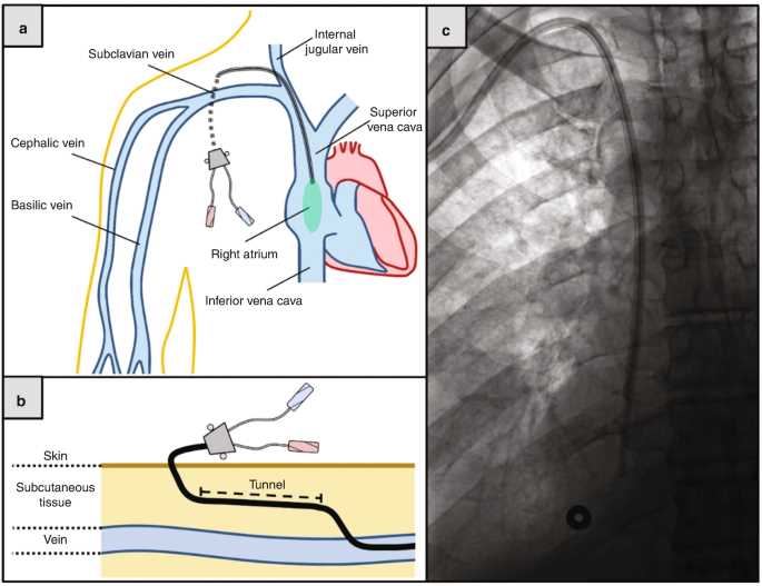 picc line parts diagram