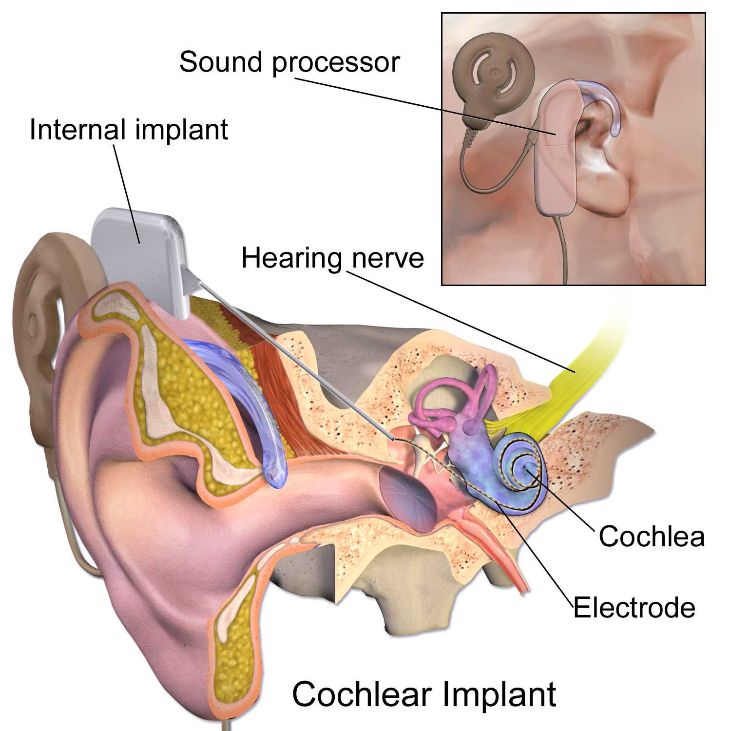 cochlear implant parts diagram